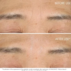 Hyalushot, Rimpel Corrector voor Bestaande & Beginnende Rimpels