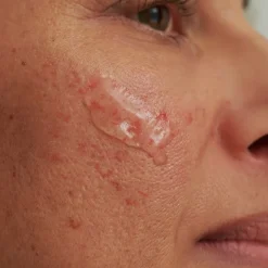 INTENSIEF SERUM, - voor overgevoelige huid & couperose